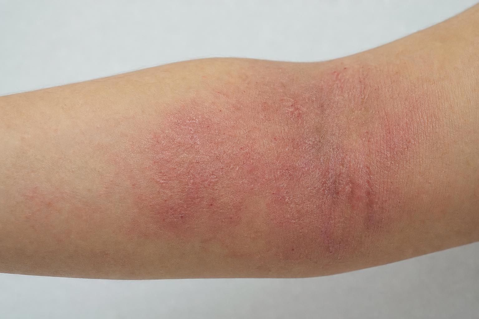 Atopic Eczema: Strategies to Soothe Flare-ups