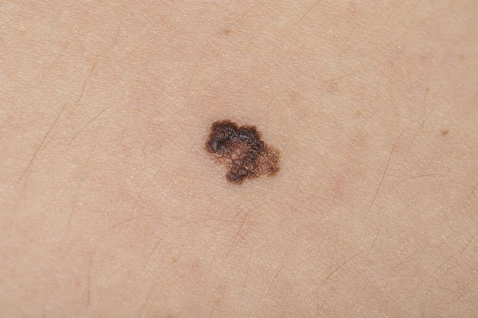 Melanoma: Warning Signs to Know