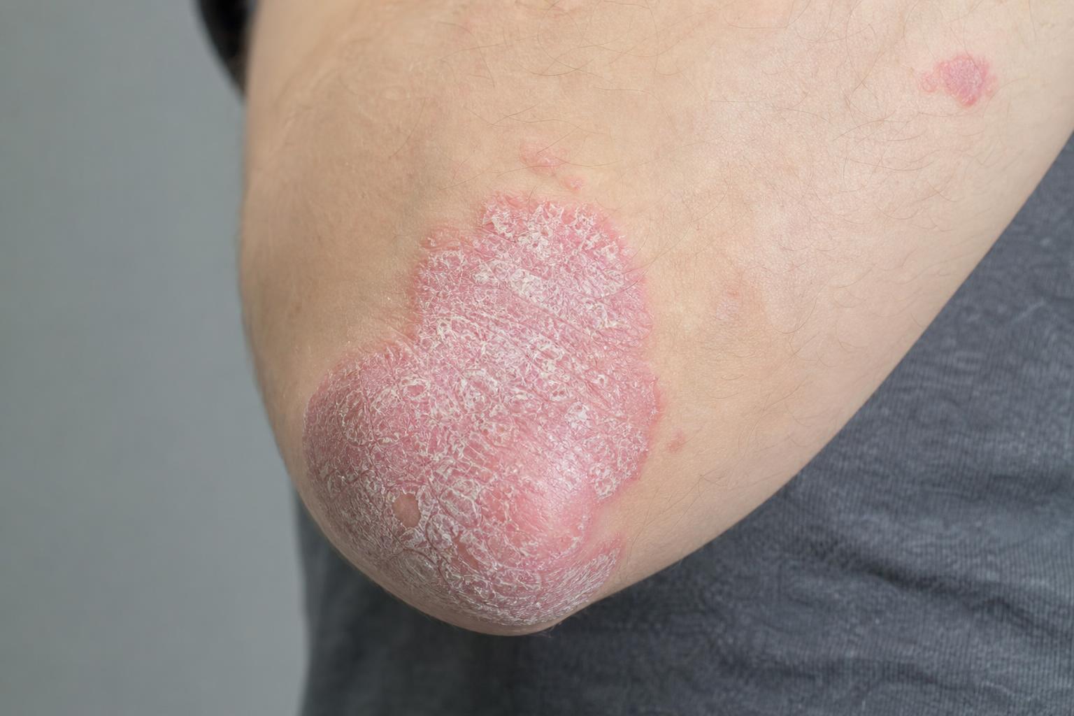 Psoriasis: Much More Than a Skin Problem