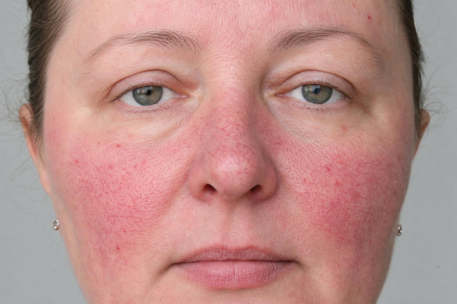 Rosacea: Understanding and Treating Facial Redness